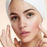 من الجبهة للذقن: ماذا تكشف أماكن الحبوب عن صحتك؟