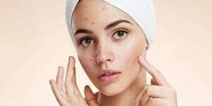 من الجبهة للذقن: ماذا تكشف أماكن الحبوب عن صحتك؟