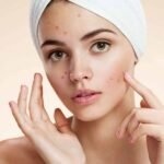 علاج حب الشباب بالطرق العلاجية المنزلية
