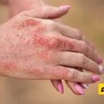 ما هو الذئبة؟ صورة توضيحية لأعراض مرض الذئبة الحمراء وتأثيره على الجسم.