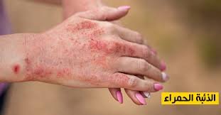 ما هو الذئبة؟ صورة توضيحية لأعراض مرض الذئبة الحمراء وتأثيره على الجسم.