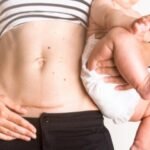 انتفاخ جرح العملية القيصرية من جهة واحدة بعد الولادة.