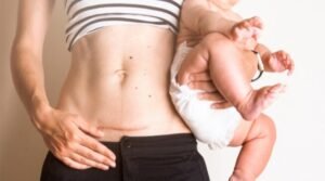 انتفاخ جرح العملية القيصرية من جهة واحدة بعد الولادة.