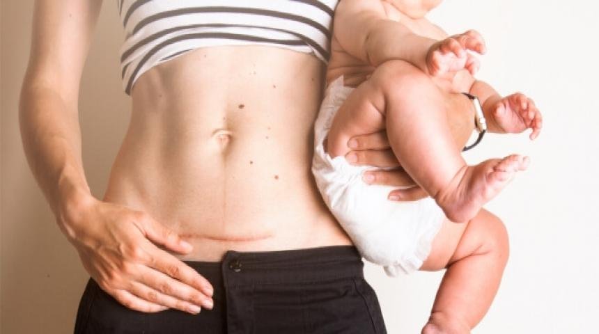 انتفاخ جرح العملية القيصرية من جهة واحدة بعد الولادة.